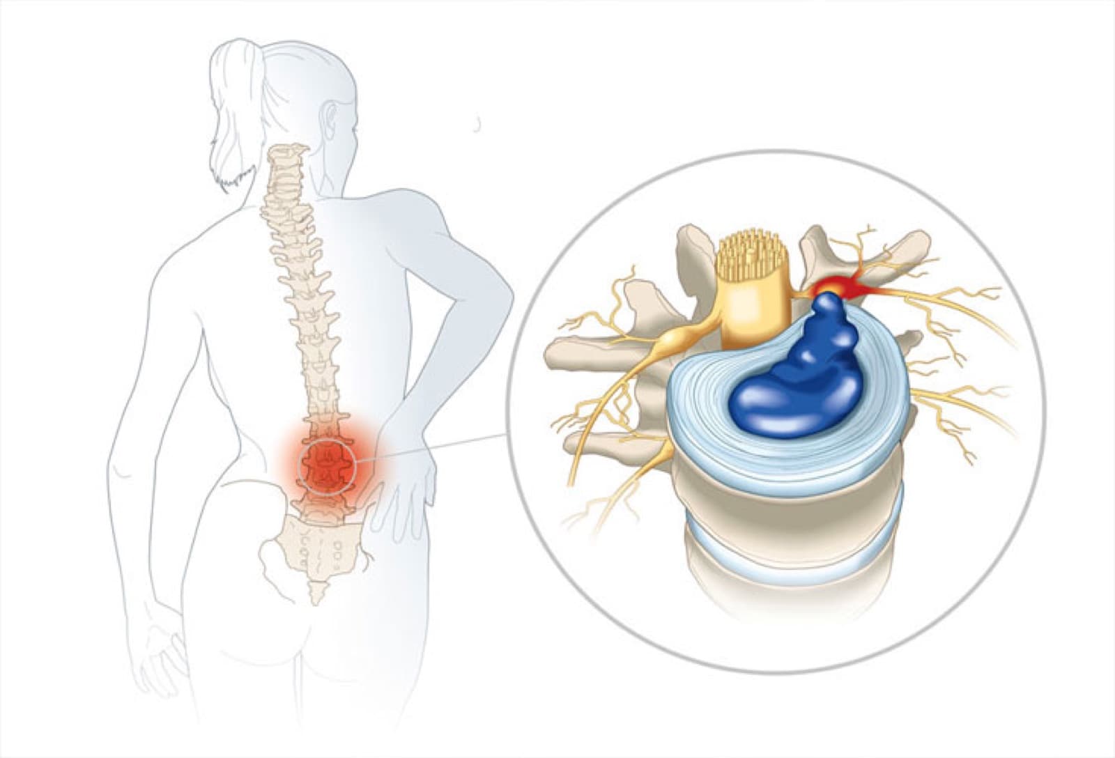 Các biến chứng nguy hiểm khi thoái hóa cột sống